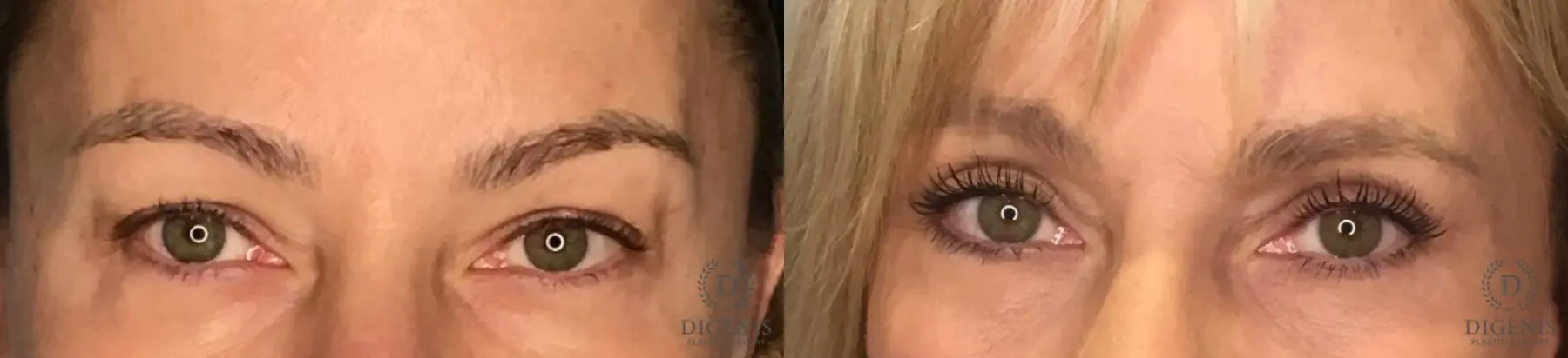 Eyelid Surgery: Patient 24 - Before and After  