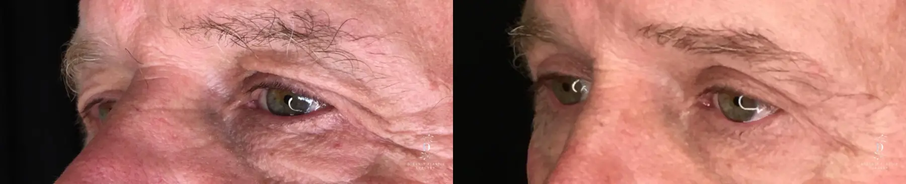Eyelid Surgery: Patient 31 - Before and After 4