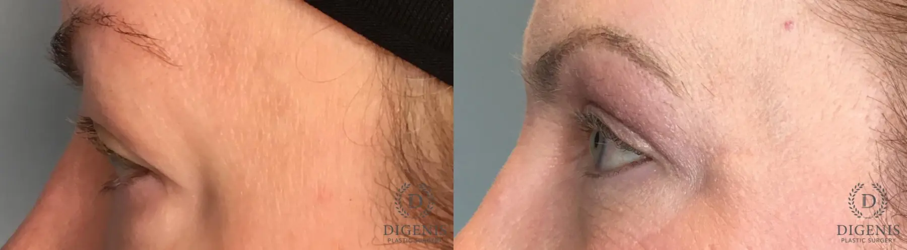 Eyelid Surgery: Patient 47 - Before and After 3