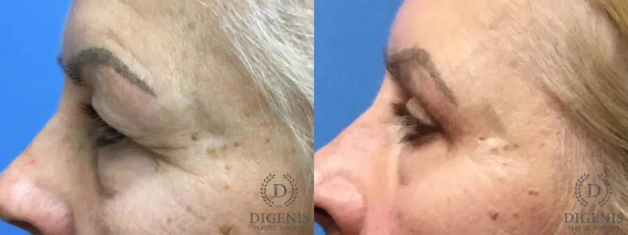 Eyelid Surgery: Patient 6 - Before and After 5