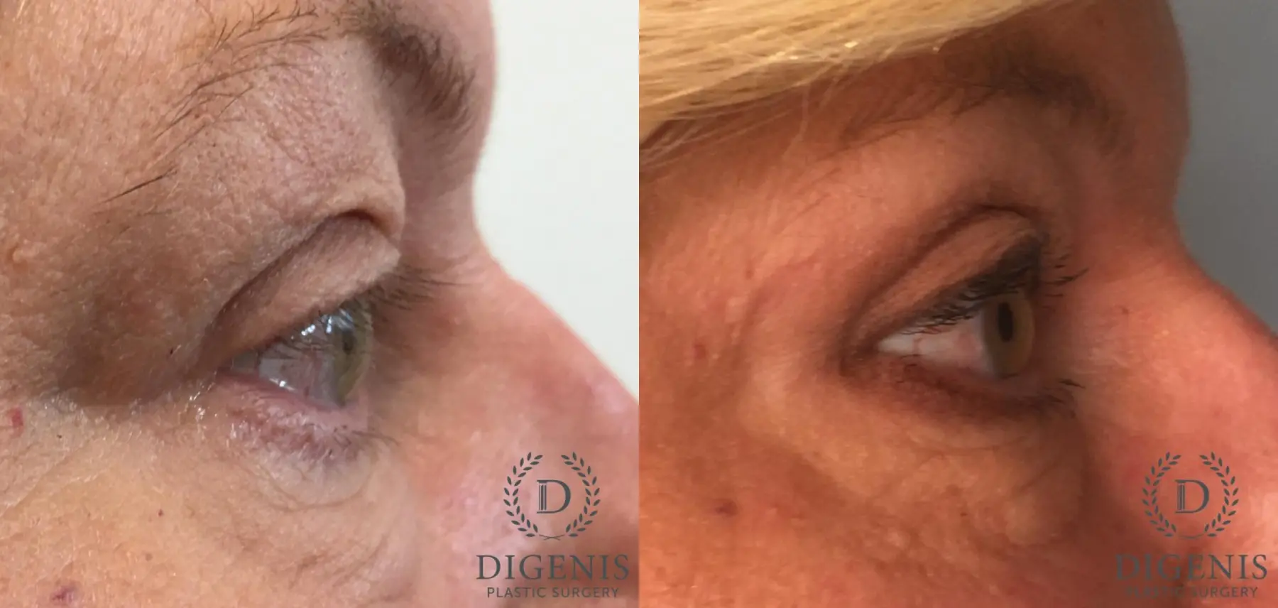 Eyelid Surgery: Patient 62 - Before and After 4