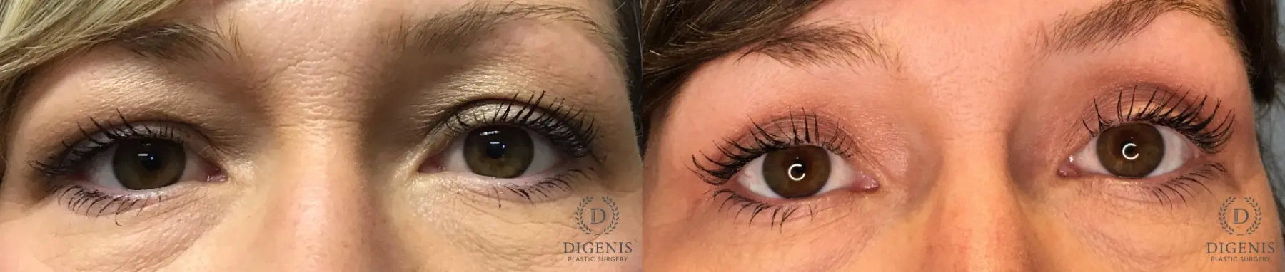 Eyelid Surgery: Patient 63 - Before and After 1