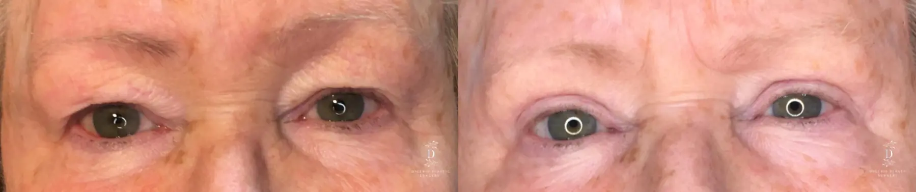 Eyelid Surgery: Patient 25 - Before and After 1