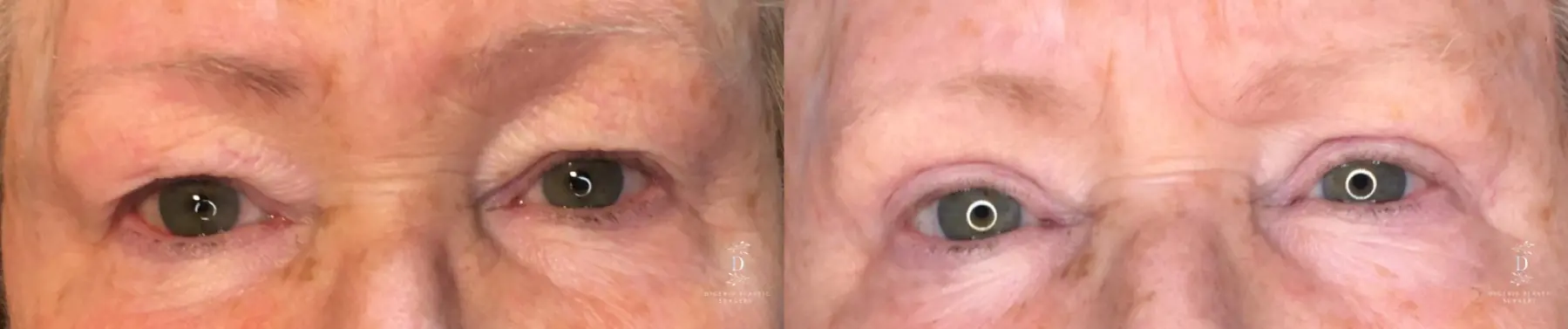 Eyelid Surgery: Patient 25 - Before and After  