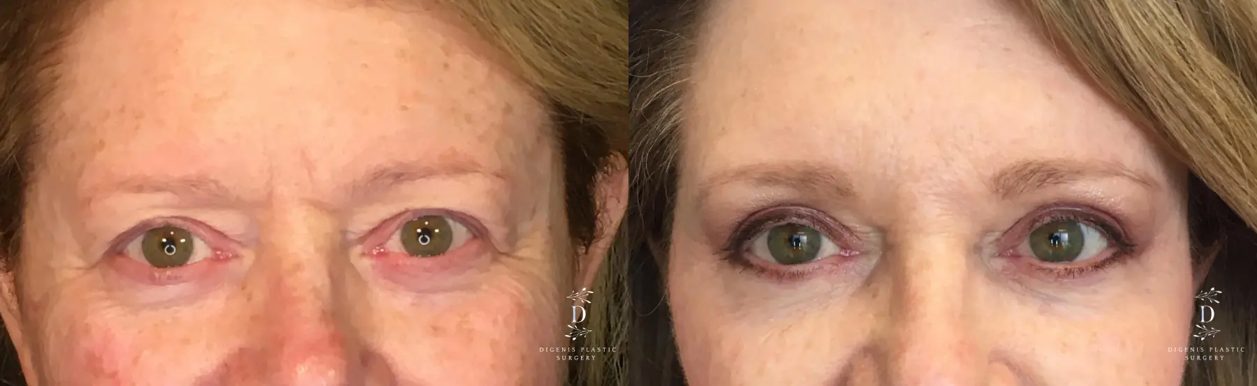 Eyelid Surgery: Patient 16 - Before and After  