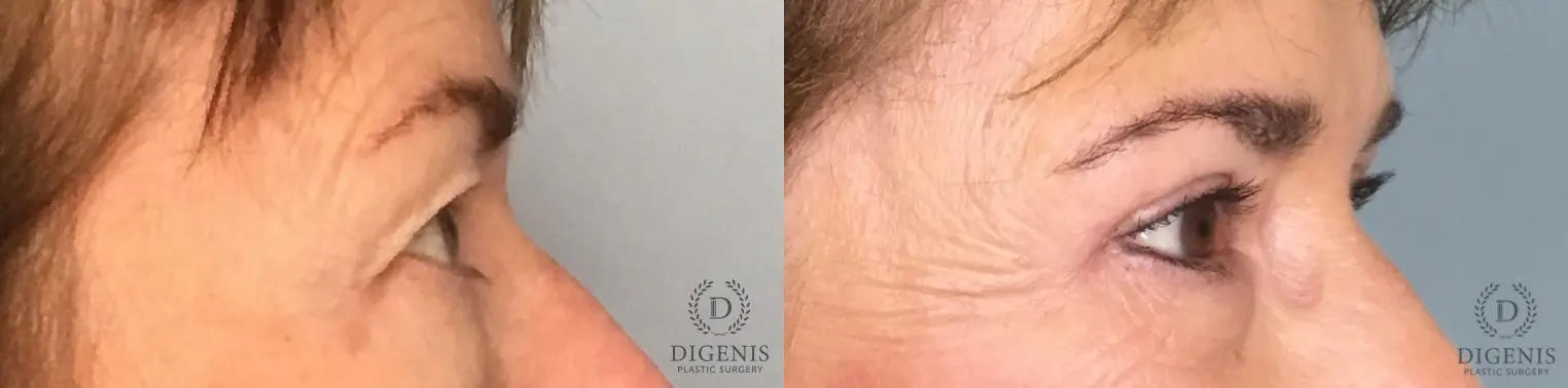 Eyelid Surgery: Patient 73 - Before and After 2