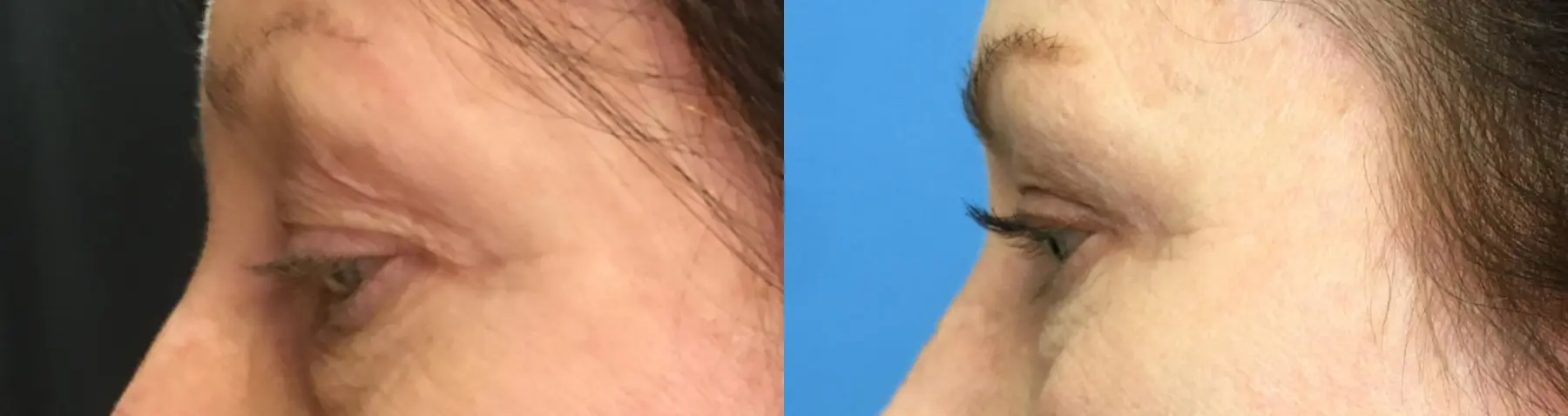 Eyelid Surgery: Patient 24 - Before and After 5