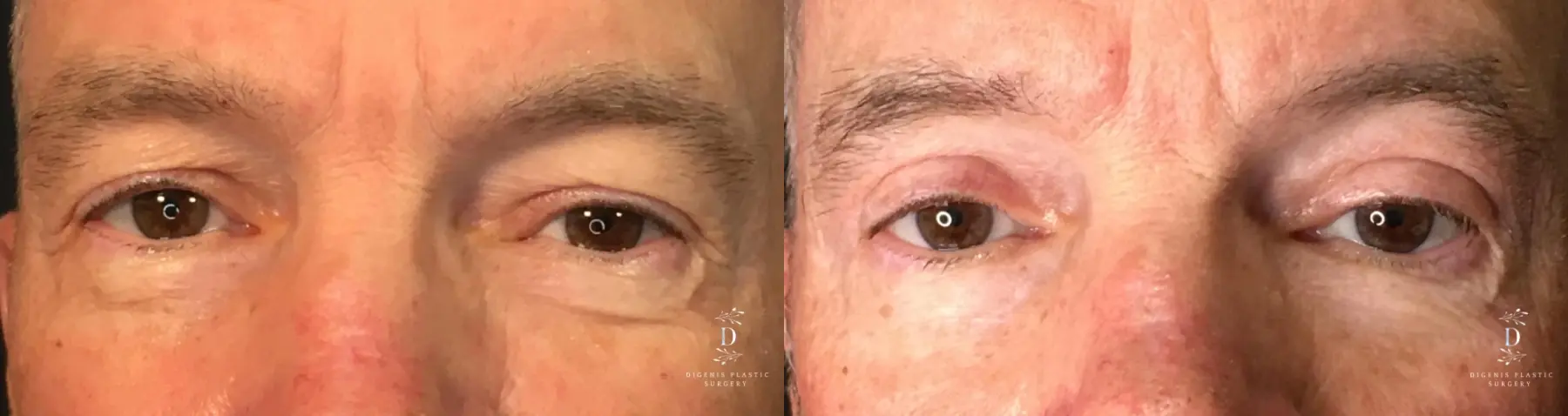 Eyelid Surgery: Patient 19 - Before and After  