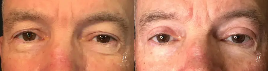 Eyelid Surgery: Patient 19 - Before and After 1