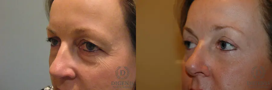 Eyelid Surgery: Patient 9 - Before and After 3