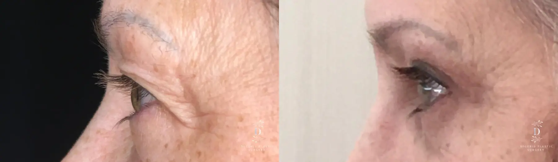 Eyelid Surgery: Patient 29 - Before and After 5