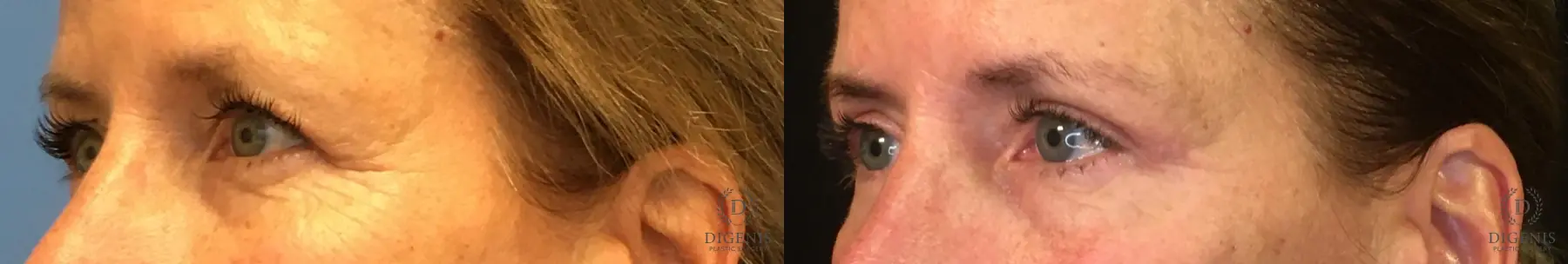 Eyelid Surgery: Patient 2 - Before and After 4