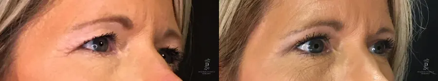 Eyelid Surgery: Patient 14 - Before and After 2