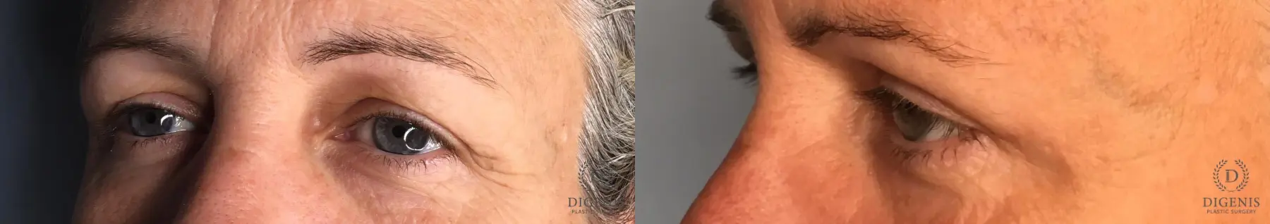 Eyelid Surgery: Patient 5 - Before and After 2
