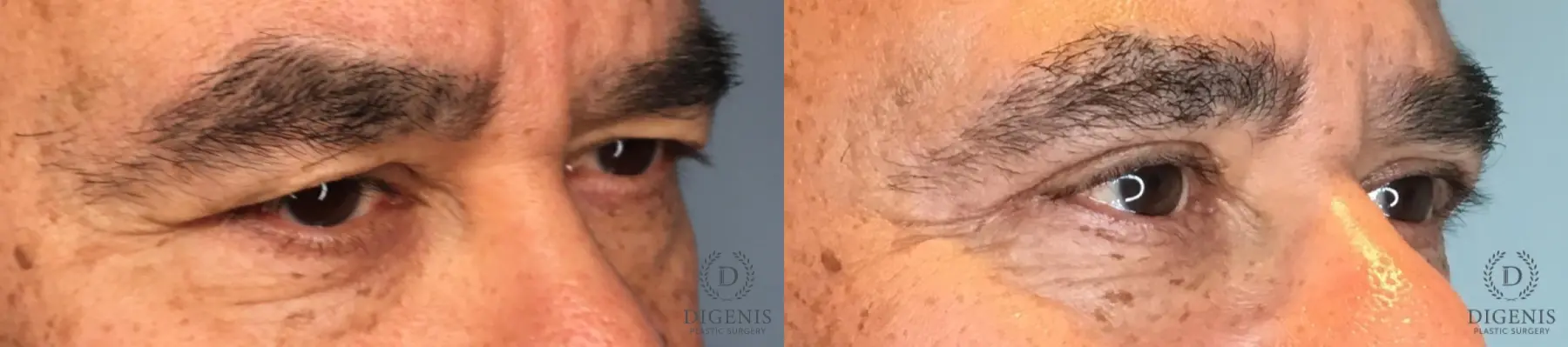 Eyelid Surgery: Patient 82 - Before and After 2