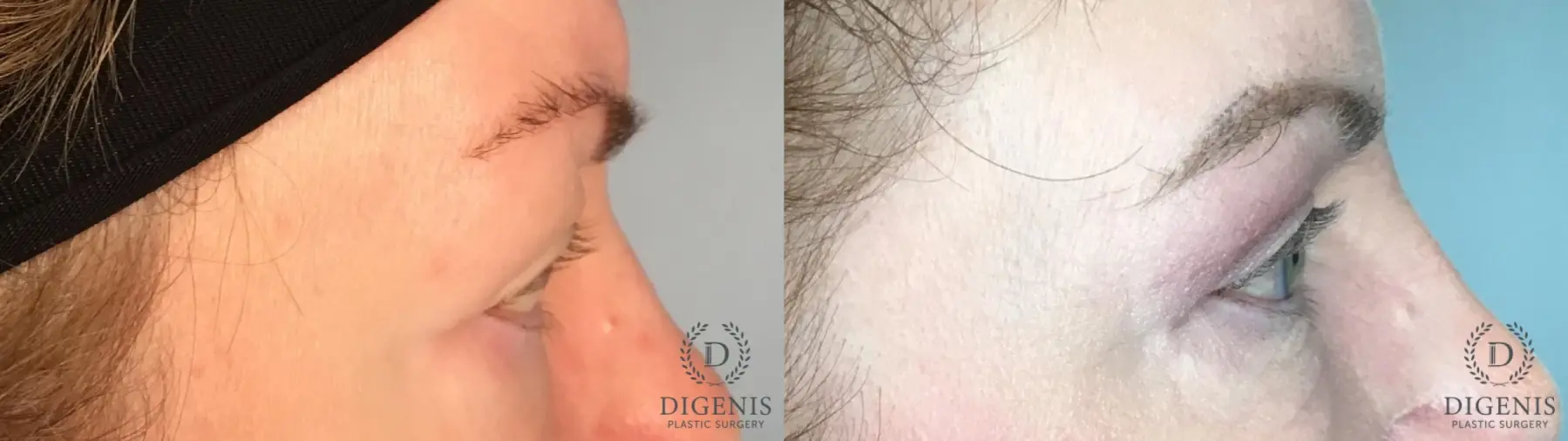 Eyelid Surgery: Patient 47 - Before and After 5