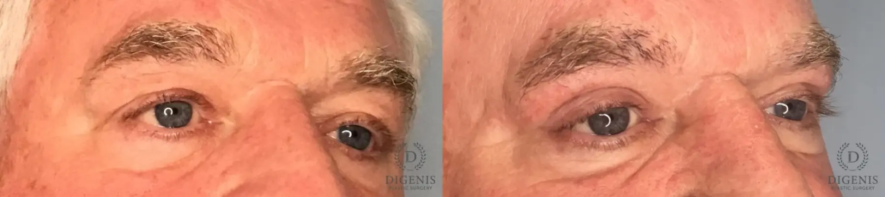 Eyelid Surgery: Patient 8 - Before and After 4