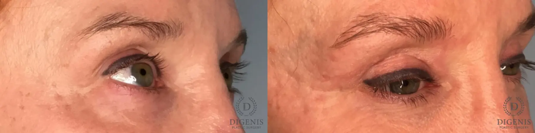 Eyelid Surgery: Patient 7 - Before and After 4