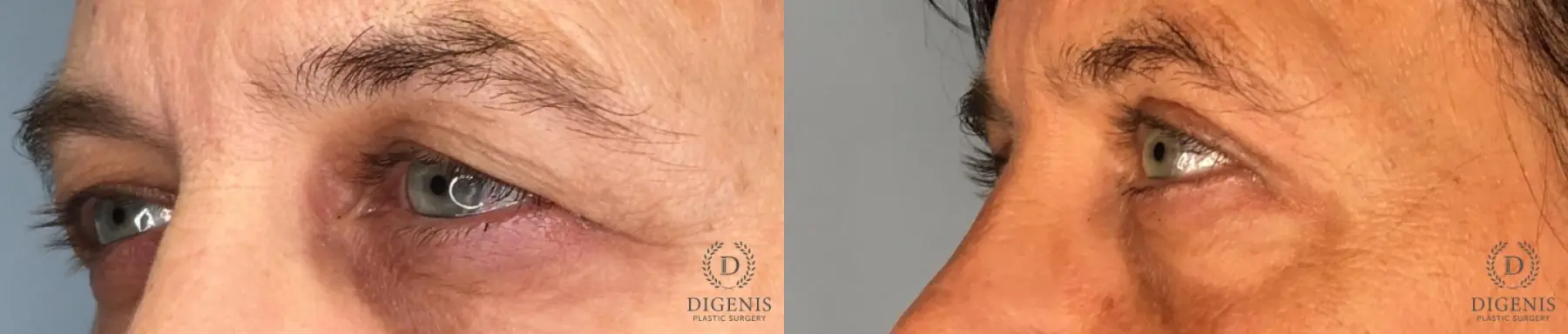 Eyelid Surgery: Patient 68 - Before and After 2