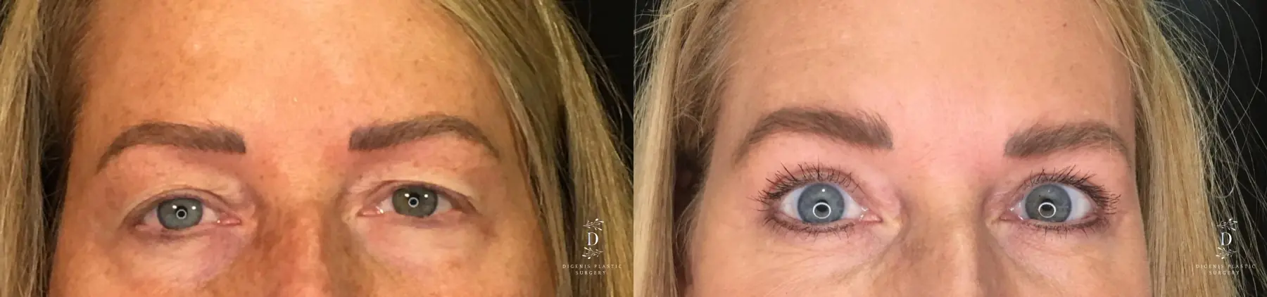 Eyelid Surgery: Patient 13 - Before and After  