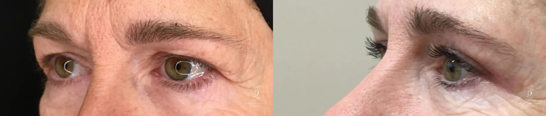 Eyelid Surgery: Patient 32 - Before and After 4