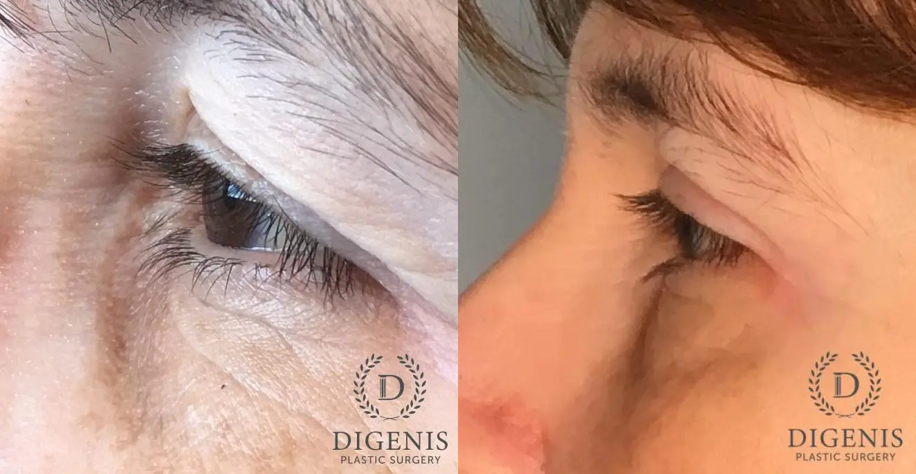 Eyelid Surgery: Patient 64 - Before and After 3