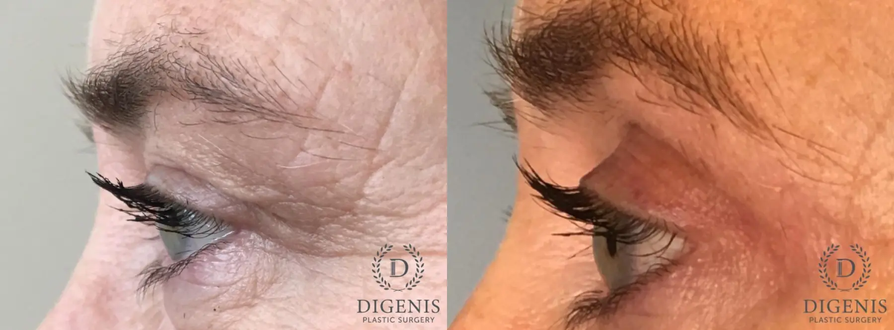 Eyelid Surgery: Patient 60 - Before and After 5