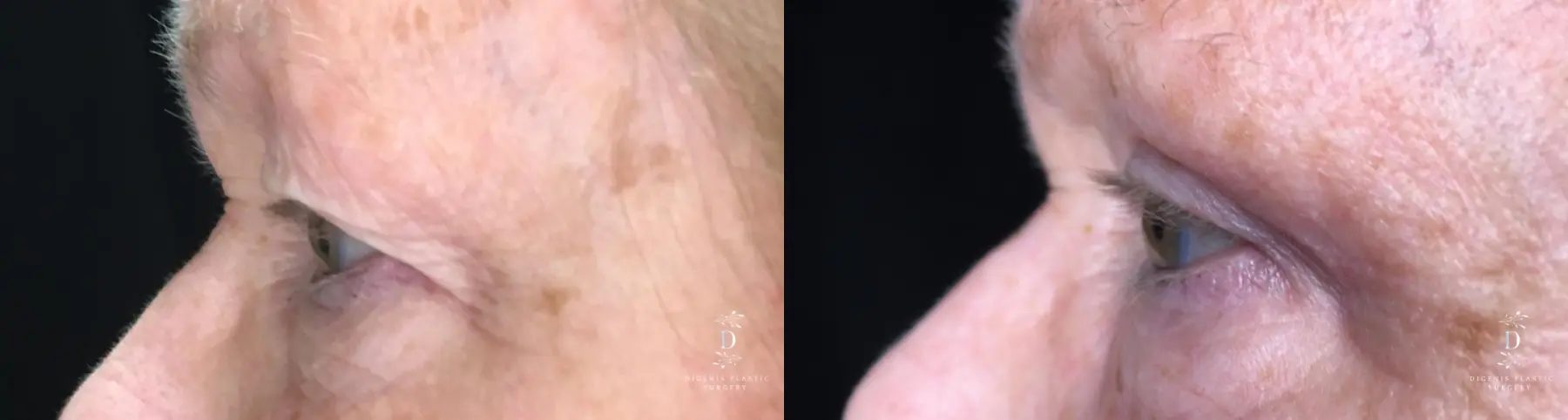 Eyelid Surgery: Patient 25 - Before and After 5