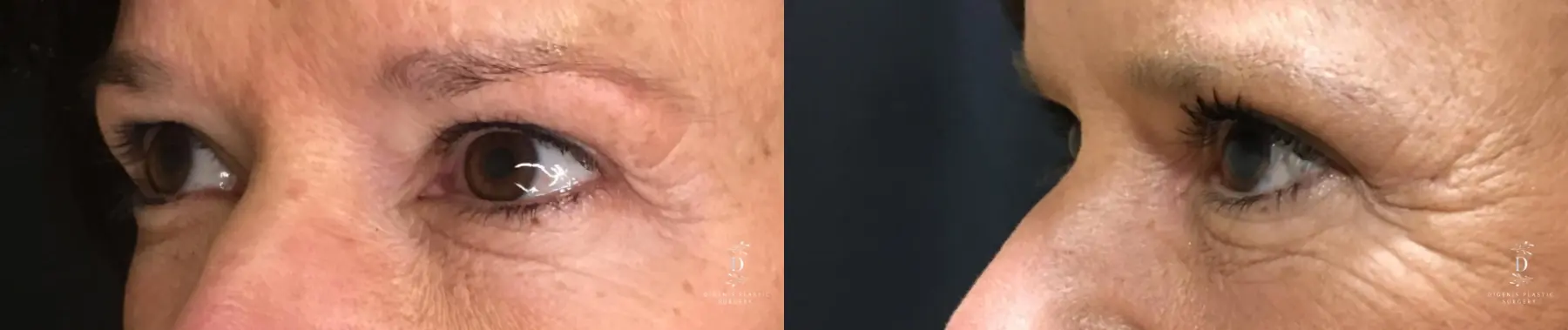 Eyelid Surgery: Patient 27 - Before and After 4