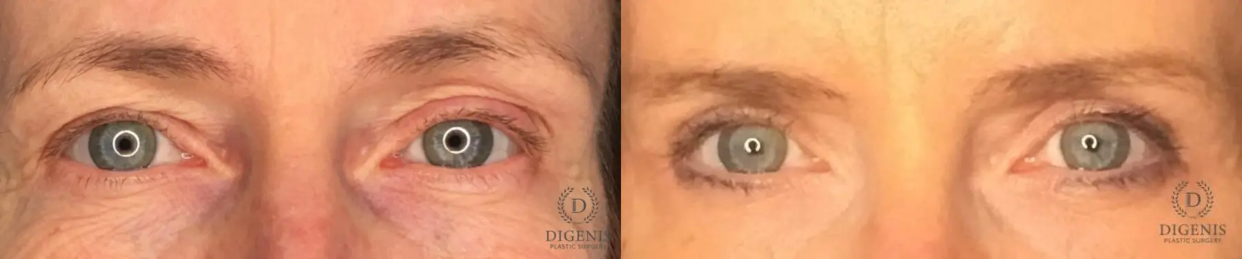 Eyelid Surgery: Patient 66 - Before and After 1