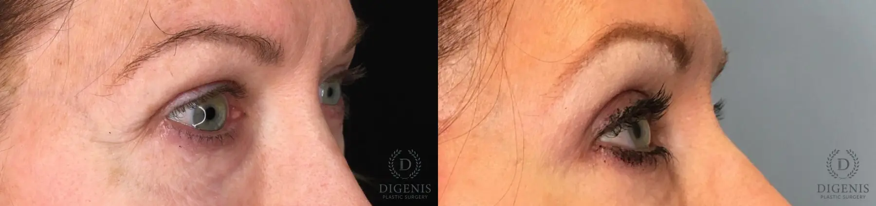 Eyelid Surgery: Patient 56 - Before and After 2