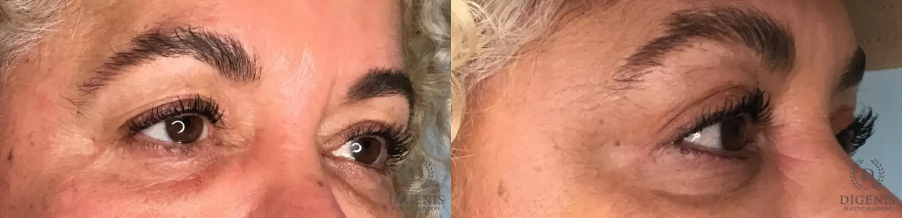 Eyelid Surgery: Patient 13 - Before and After 4