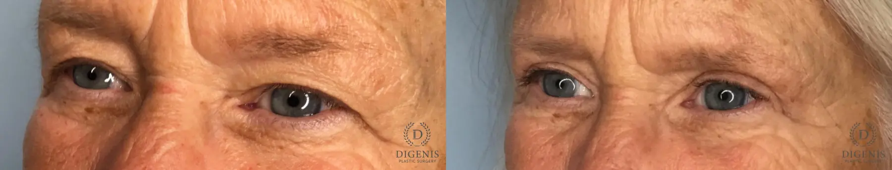 Eyelid Surgery: Patient 4 - Before and After 2