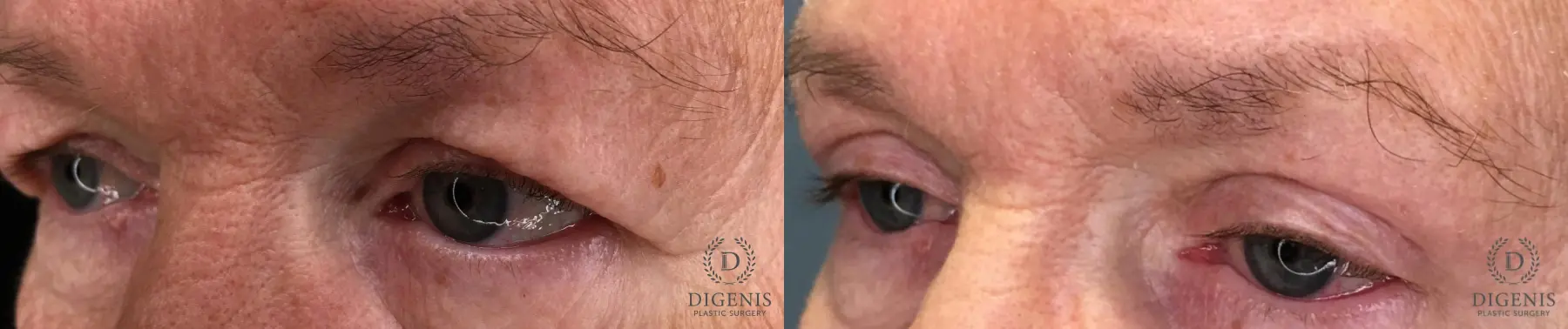 Eyelid Surgery: Patient 61 - Before and After 4
