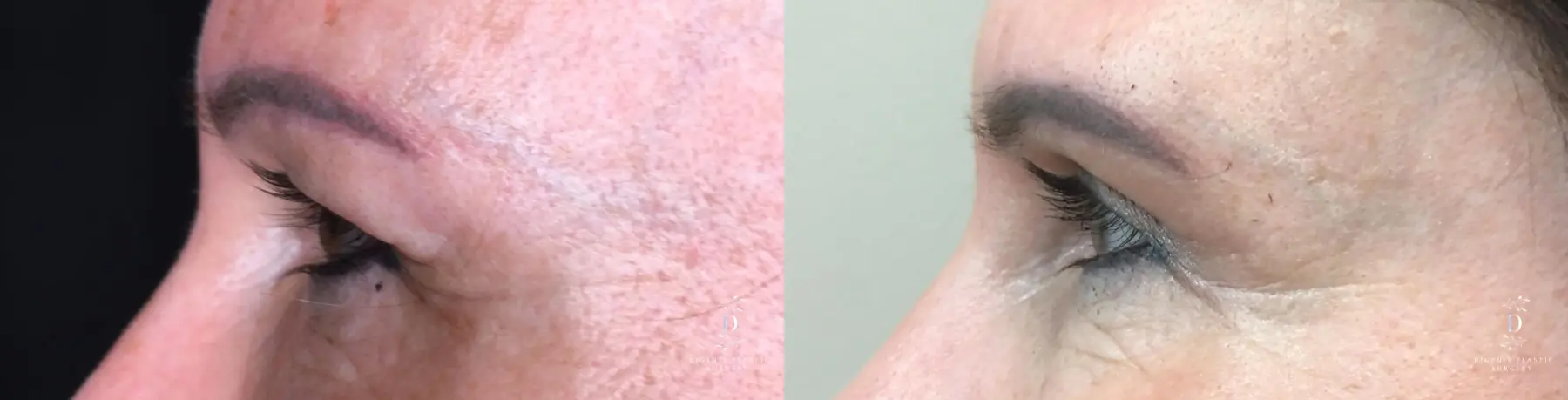 Eyelid Surgery: Patient 28 - Before and After 5