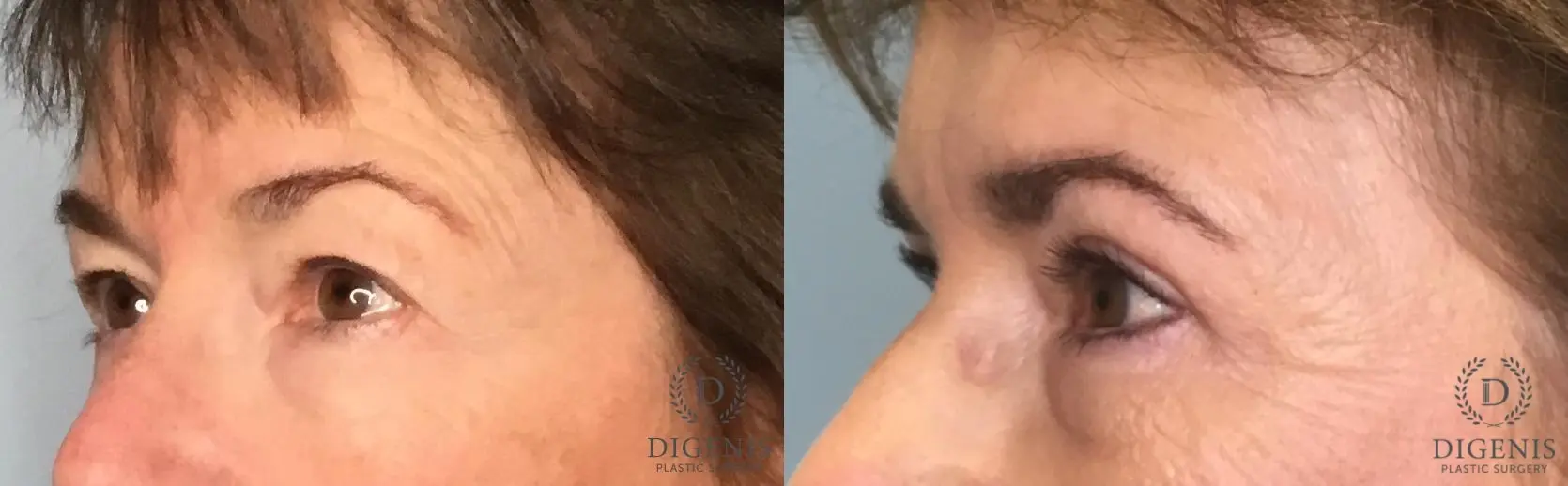 Eyelid Surgery: Patient 73 - Before and After 3