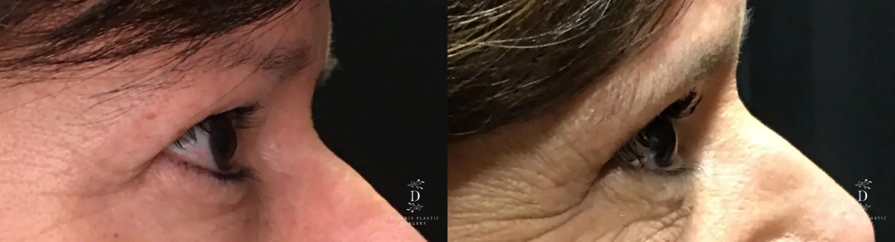 Eyelid Surgery: Patient 27 - Before and After 3