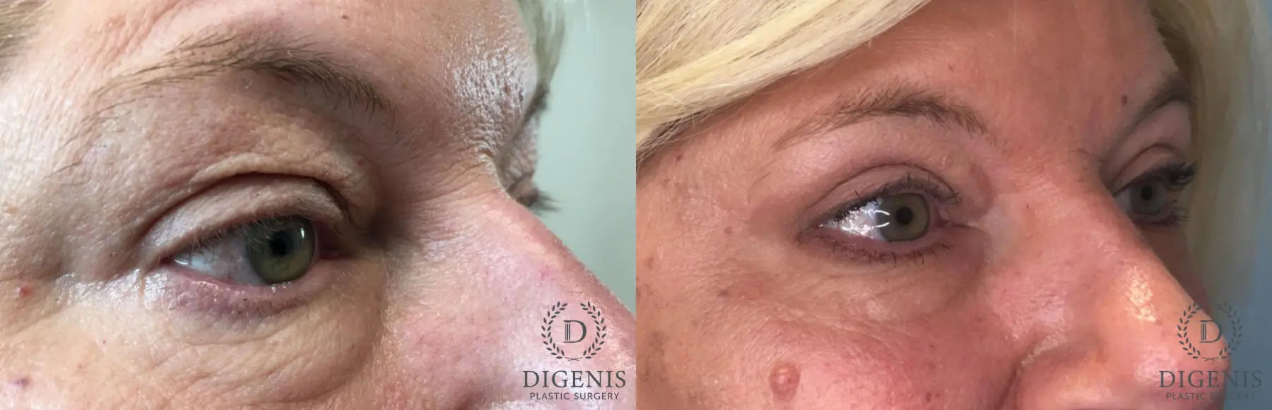 Eyelid Surgery: Patient 62 - Before and After 3