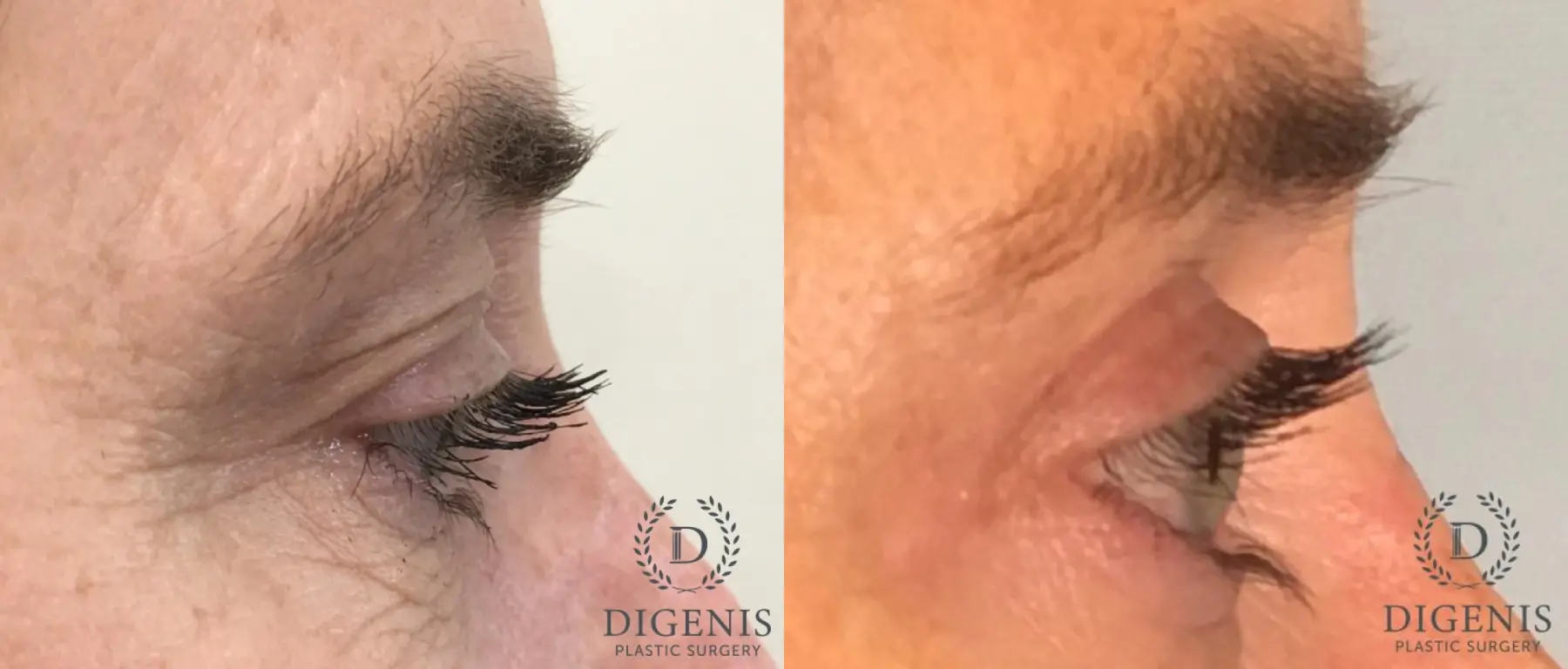 Eyelid Surgery: Patient 60 - Before and After 4
