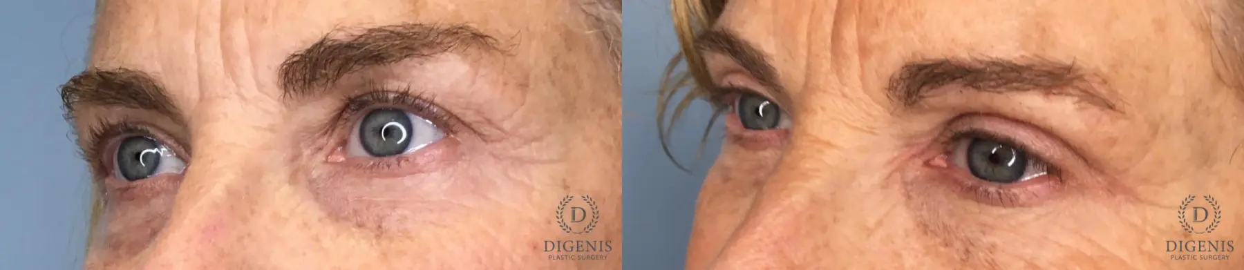 Eyelid Surgery: Patient 10 - Before and After 3