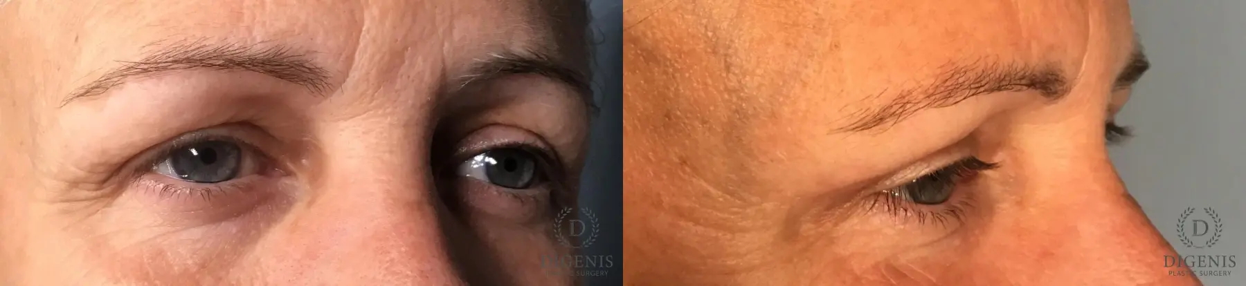 Eyelid Surgery: Patient 5 - Before and After 4