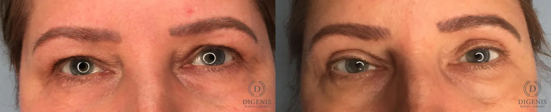 Eyelid Surgery: Patient 74 - Before and After 1