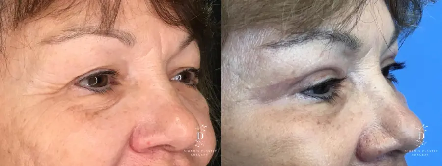Eyelid Surgery: Patient 20 - Before and After 2