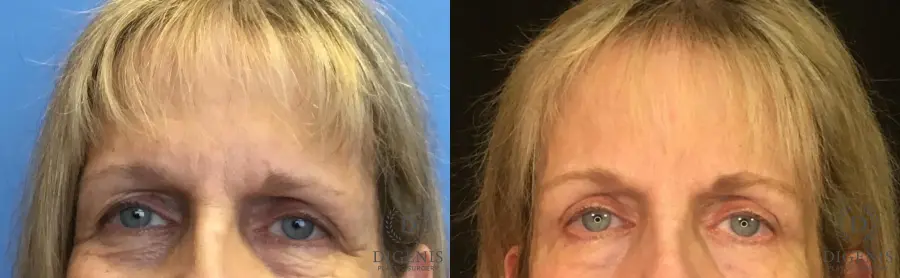 Eyelid Surgery: Patient 5 - Before and After 1