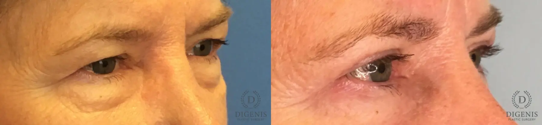Eyelid Surgery: Patient 58 - Before and After 2