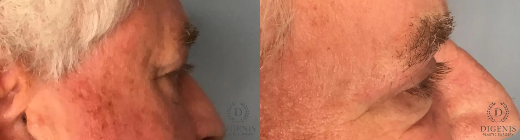 Eyelid Surgery: Patient 8 - Before and After 5