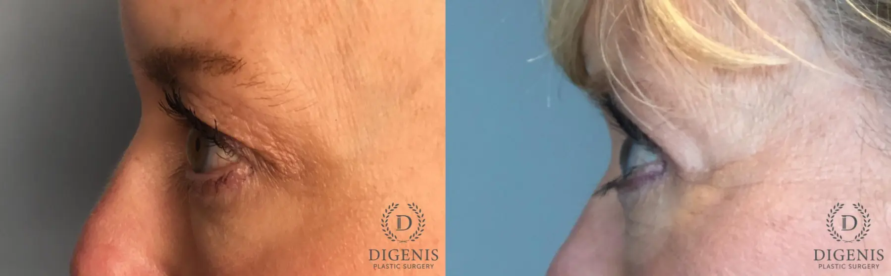 Eyelid Surgery: Patient 80 - Before and After 3