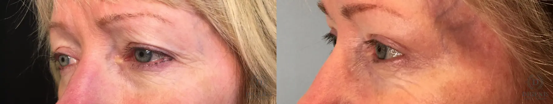 Eyelid Surgery: Patient 34 - Before and After 3