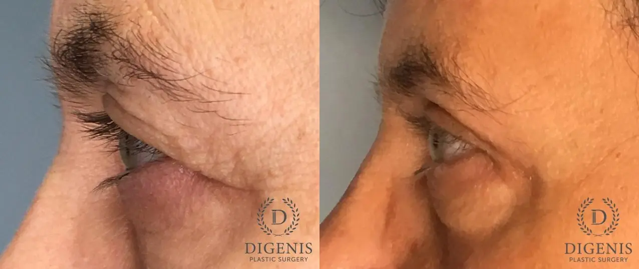 Eyelid Surgery: Patient 68 - Before and After 3