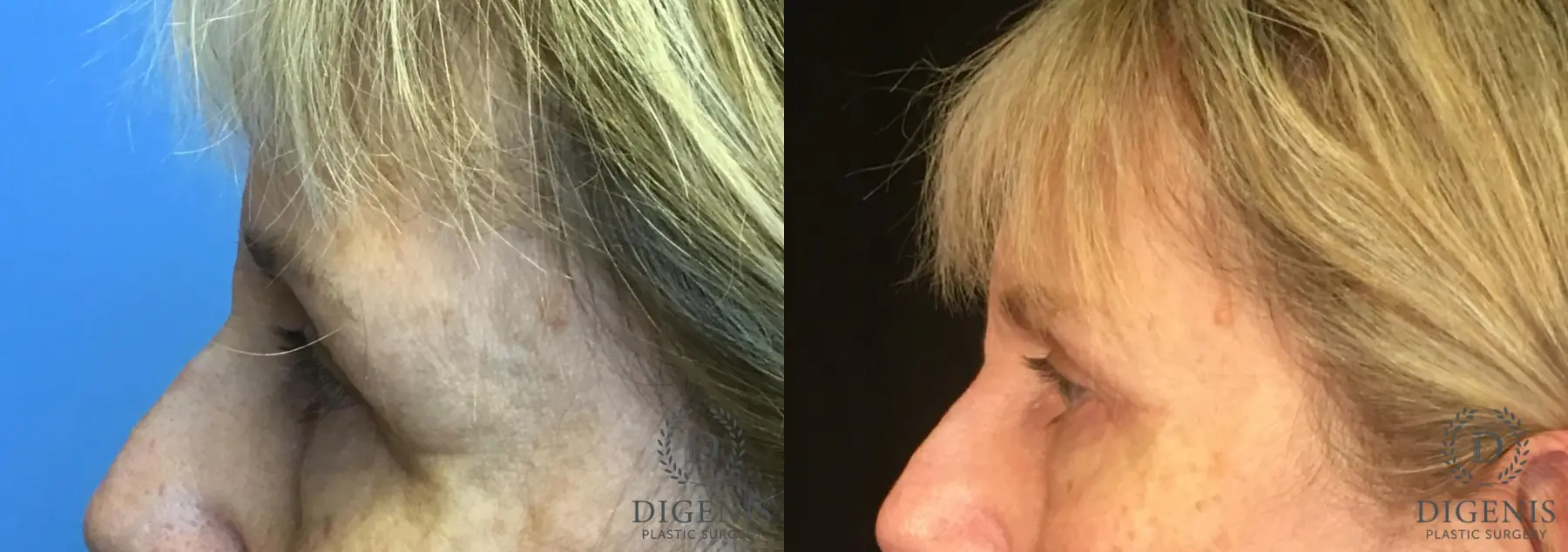 Eyelid Surgery: Patient 5 - Before and After 5